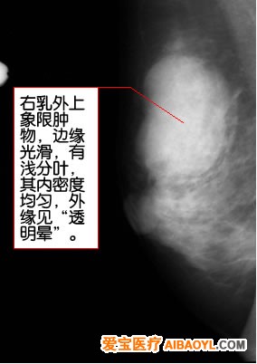 认识乳腺钼靶照片 - 马夫 - 马夫的博客