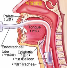 气管插管术