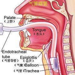 气管插管22