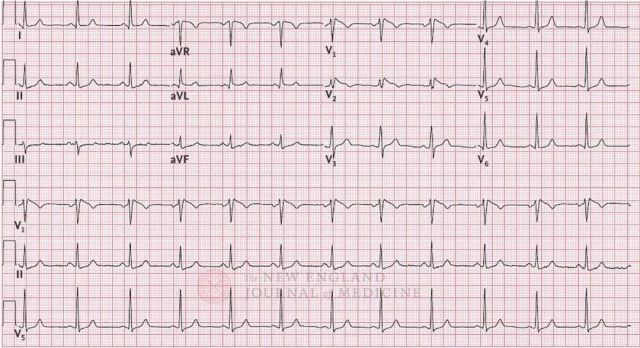 NEJM 丨 ICD 植入又取出还放了支架，她的坎坷经历究竟为哪般？