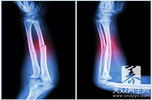 骨折可以艾灸吗